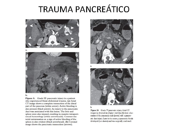 TRAUMA PANCREÁTICO 