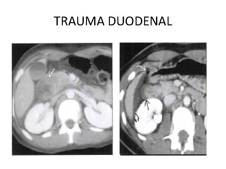 TRAUMA DUODENAL 