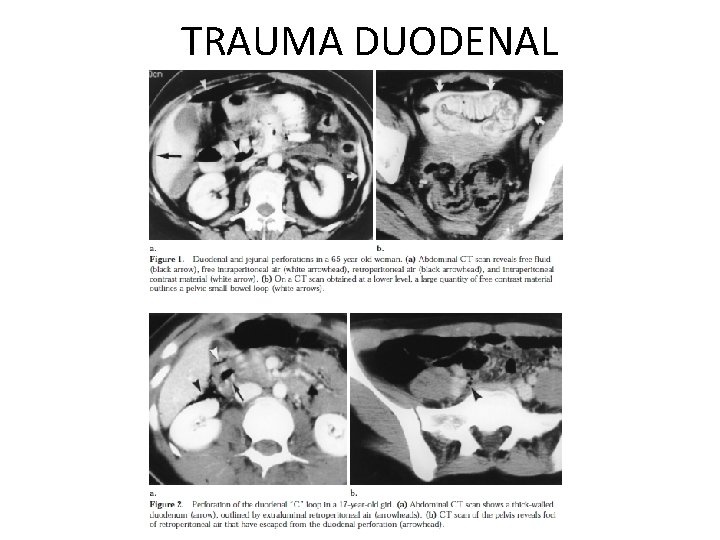 TRAUMA DUODENAL 