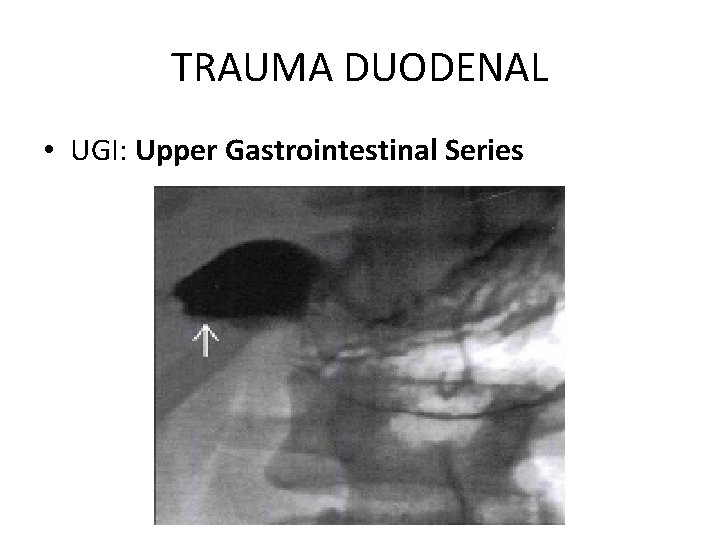 TRAUMA DUODENAL • UGI: Upper Gastrointestinal Series 