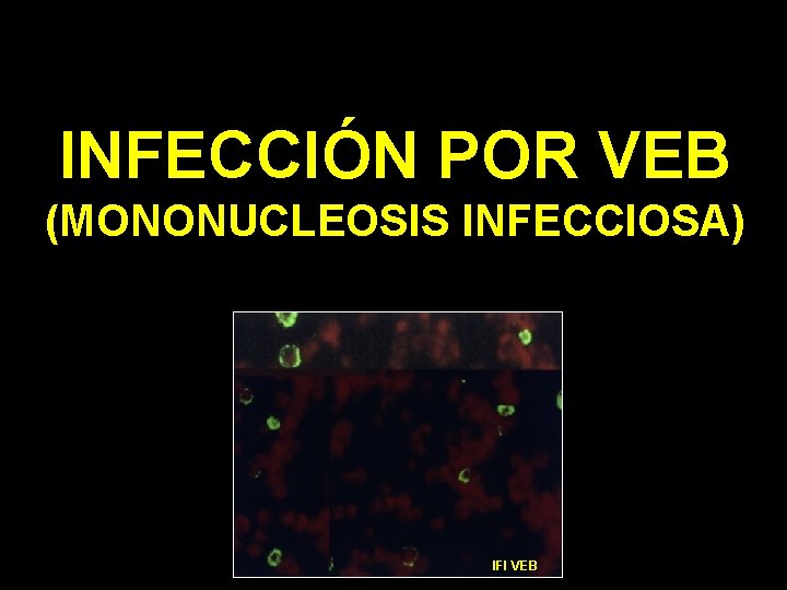 INFECCIÓN POR VEB (MONONUCLEOSIS INFECCIOSA) IFI VEB 