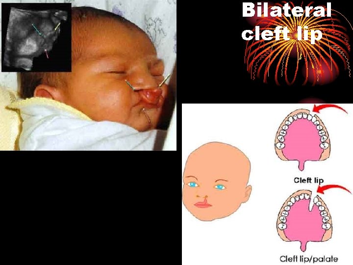 Bilateral cleft lip 