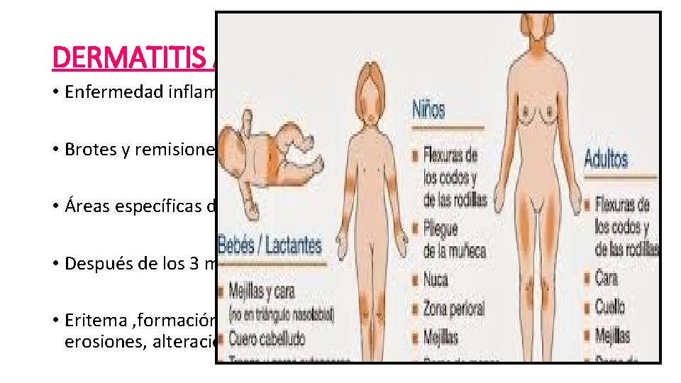 DERMATITIS ATÓPICA • Enfermedad inflamatoria crónica de la piel • Brotes y remisiones •