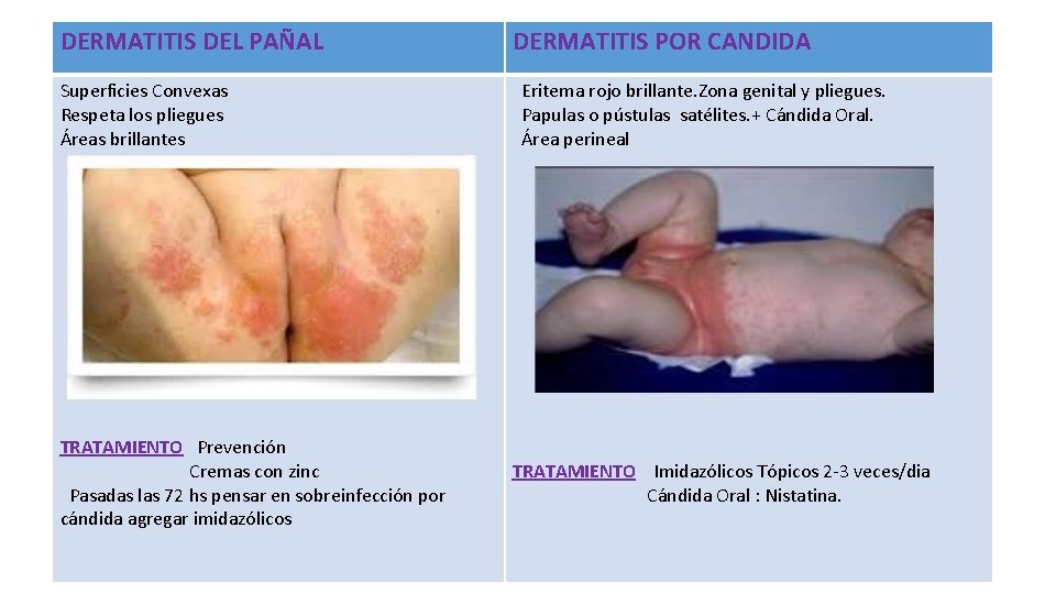 DERMATITIS DEL PAÑAL Superficies Convexas Respeta los pliegues Áreas brillantes TRATAMIENTO Prevención Cremas con