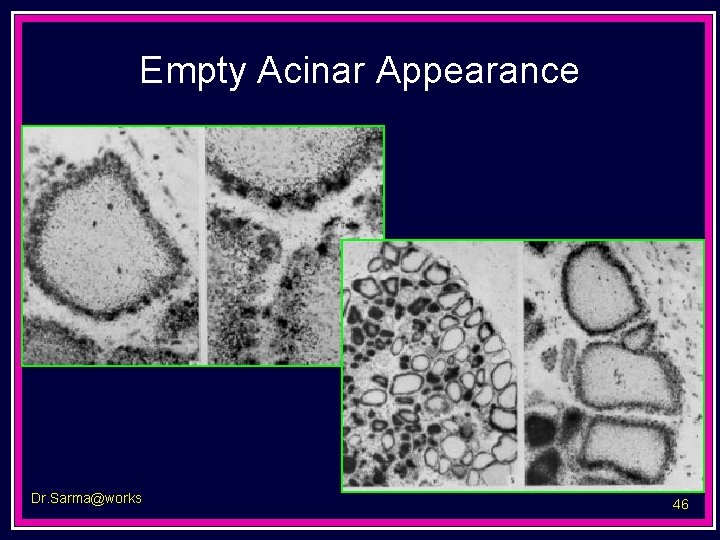 Empty Acinar Appearance Dr. Sarma@works 46 