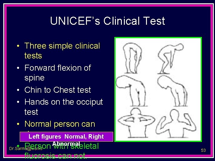 UNICEF’s Clinical Test • Three simple clinical tests • Forward flexion of spine •