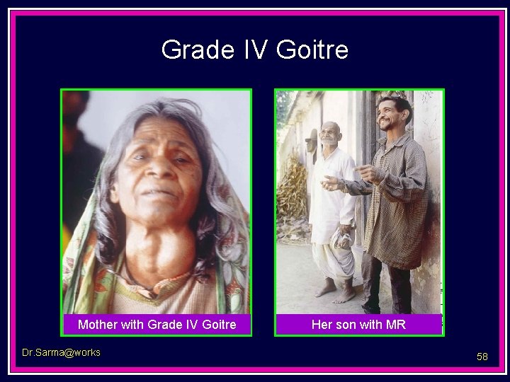 Grade IV Goitre Mother with Grade IV Goitre Dr. Sarma@works Her son with MR