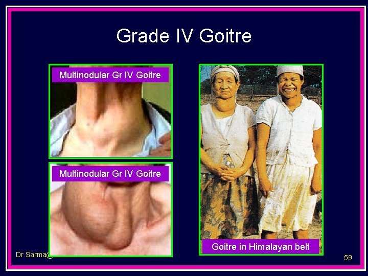 Grade IV Goitre Multinodular Gr IV Goitre Dr. Sarma@works Goitre in Himalayan belt 59