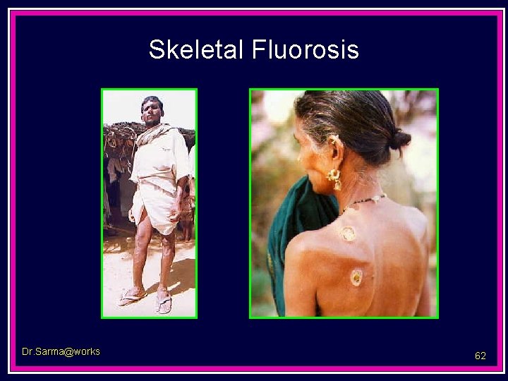 Skeletal Fluorosis Dr. Sarma@works 62 