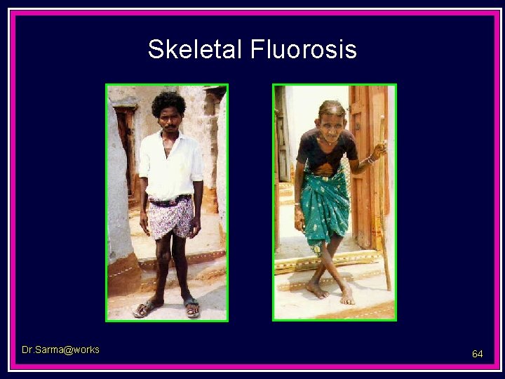 Skeletal Fluorosis Dr. Sarma@works 64 