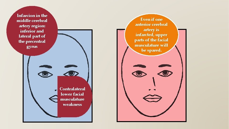 Infarcion in the middle cerebral artery region: inferior and lateral part of the precentral