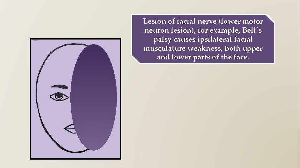 Lesion of facial nerve (lower motor neuron lesion), for example, Bell´s palsy causes ipsilateral