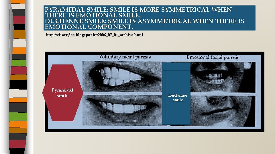 PYRAMIDAL SMILE: SMILE IS MORE SYMMETRICAL WHEN THERE IS EMOTIONAL SMILE. DUCHENNE SMILE: SMILE PYRAMIDAL SMILE: SMILE IS MORE SYMMETRICAL WHEN THERE IS EMOTIONAL SMILE. DUCHENNE SMILE: SMILE