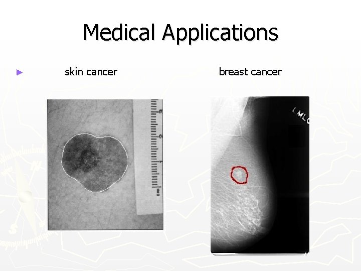 Medical Applications ► skin cancer breast cancer 