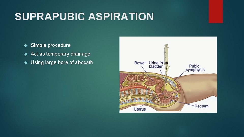 SUPRAPUBIC ASPIRATION Simple procedure Act as temporary drainage Using large bore of abocath 