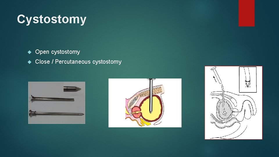 Cystostomy Open cystostomy Close / Percutaneous cystostomy 
