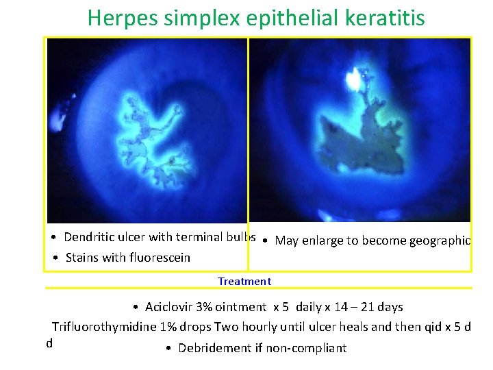 Herpes simplex epithelial keratitis • Dendritic ulcer with terminal bulbs • May enlarge to