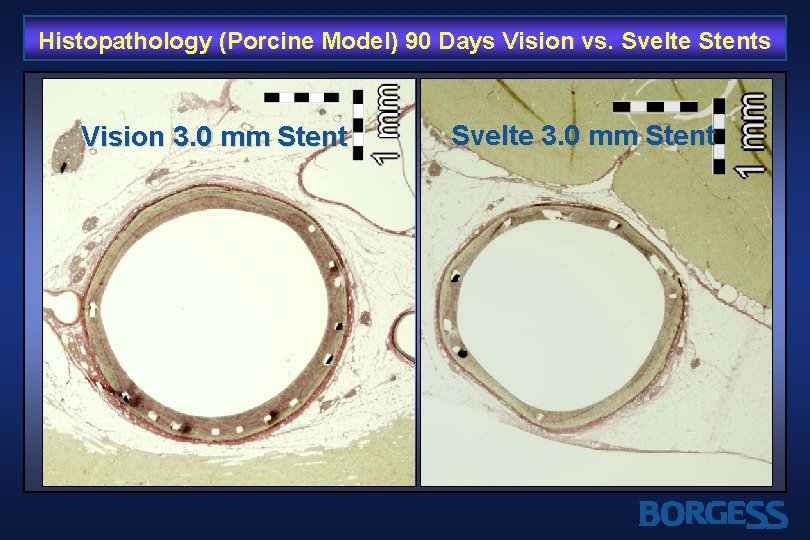 Histopathology (Porcine Model) 90 Days Vision vs. Svelte Stents Vision 3. 0 mm Stent