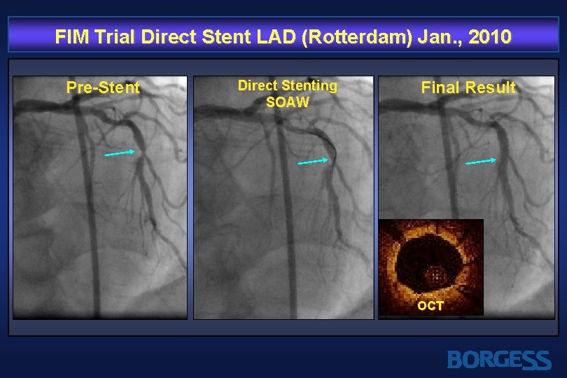 FIM Trial Direct Stent LAD (Rotterdam) Jan. , 2010 Pre-Stent Direct Stenting SOAW Final