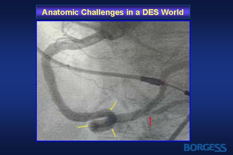 Anatomic Challenges in a DES World 
