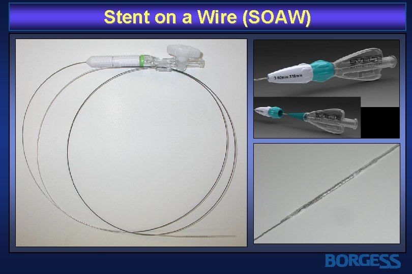 Stent on a Wire (SOAW) 