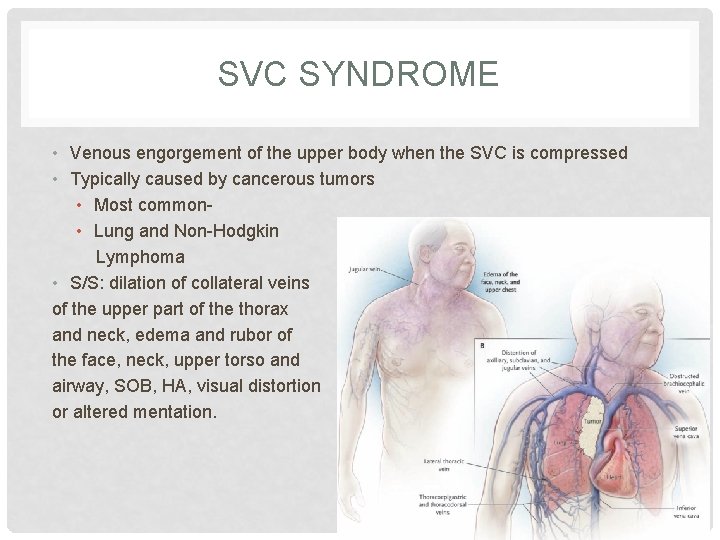 SVC SYNDROME • Venous engorgement of the upper body when the SVC is compressed SVC SYNDROME • Venous engorgement of the upper body when the SVC is compressed