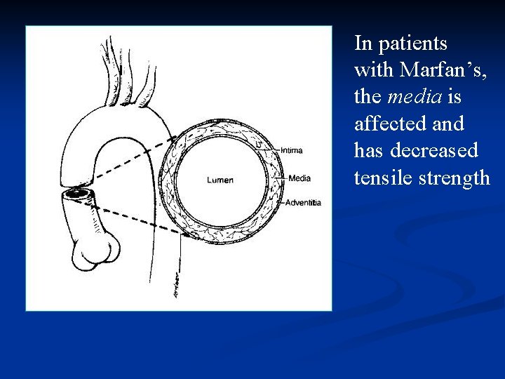 In patients with Marfan’s, the media is affected and has decreased tensile strength 