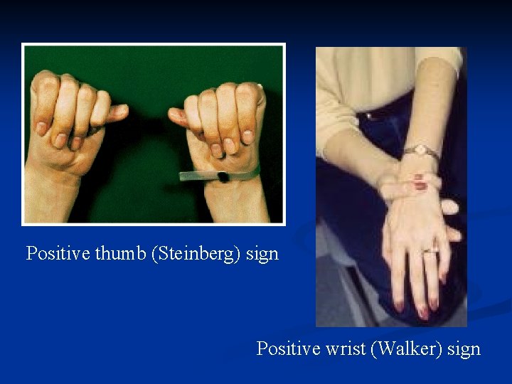 Positive thumb (Steinberg) sign Positive wrist (Walker) sign 