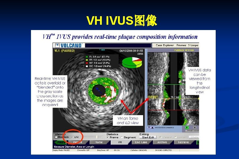 VH IVUS图像 