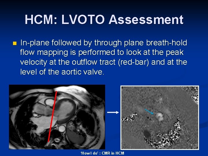 HCM: LVOTO Assessment n In-plane followed by through plane breath-hold flow mapping is performed