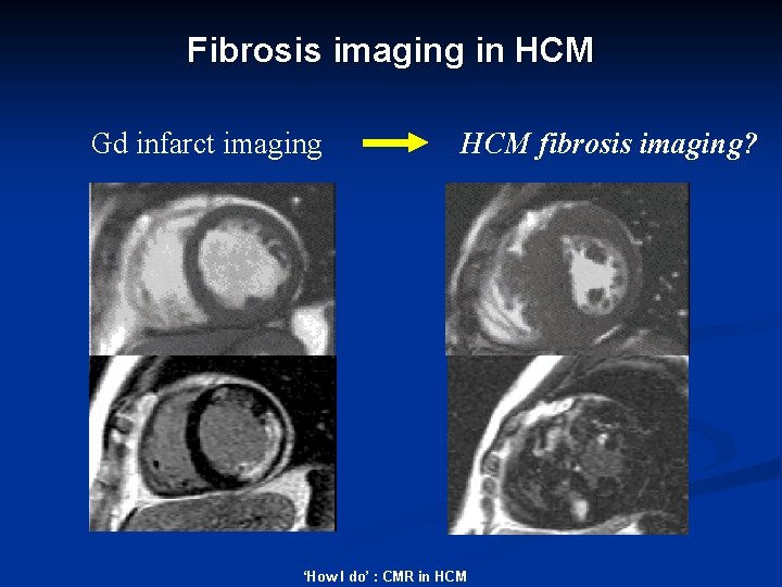 Fibrosis imaging in HCM Gd infarct imaging HCM fibrosis imaging? ‘How I do’ :