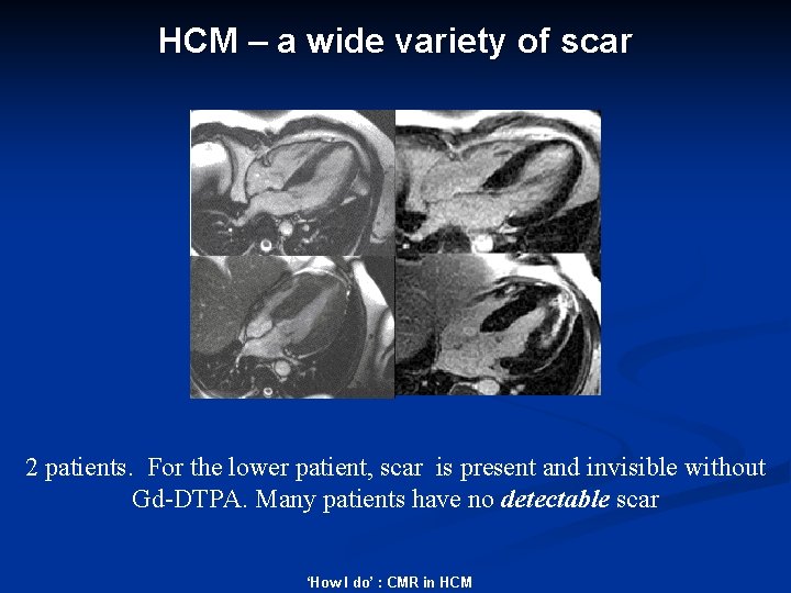 HCM – a wide variety of scar 2 patients. For the lower patient, scar