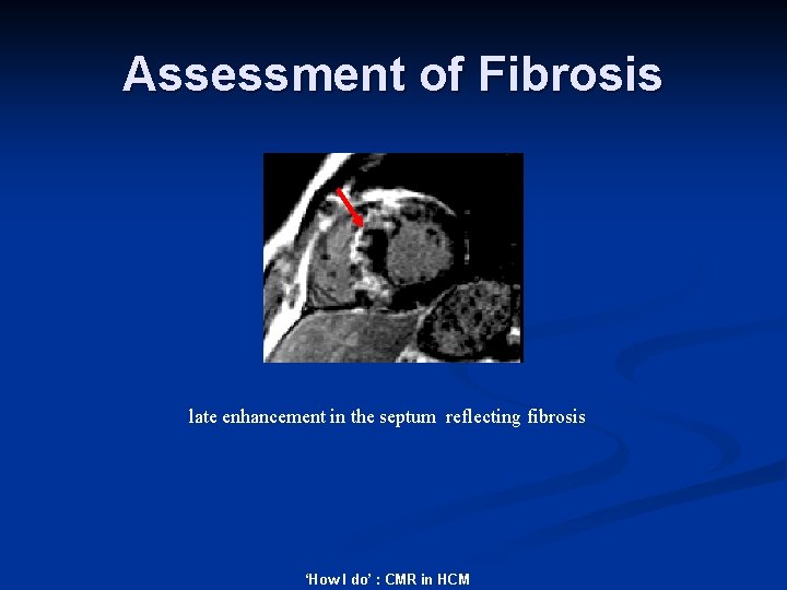Assessment of Fibrosis late enhancement in the septum reflecting fibrosis ‘How I do’ :