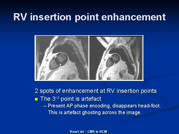 RV insertion point enhancement 2 spots of enhancement at RV insertion points n The
