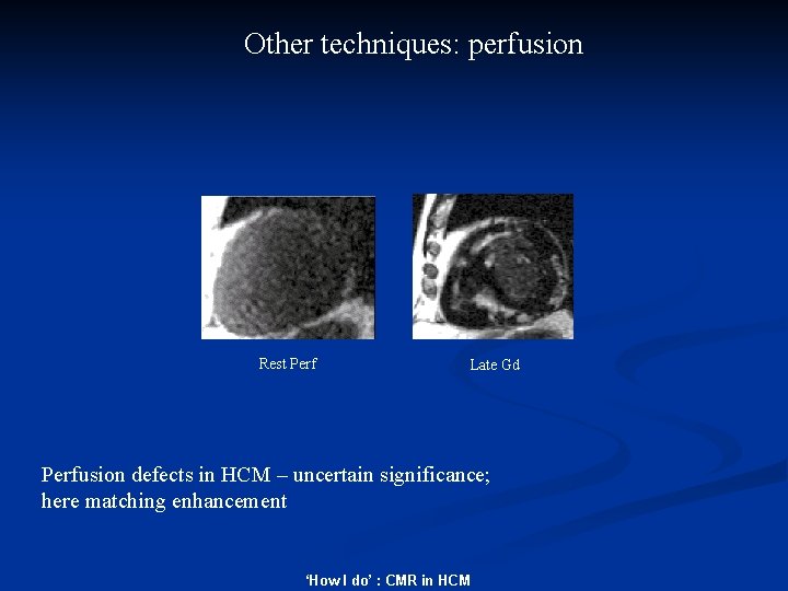 Other techniques: perfusion Rest Perf Late Gd Perfusion defects in HCM – uncertain significance;
