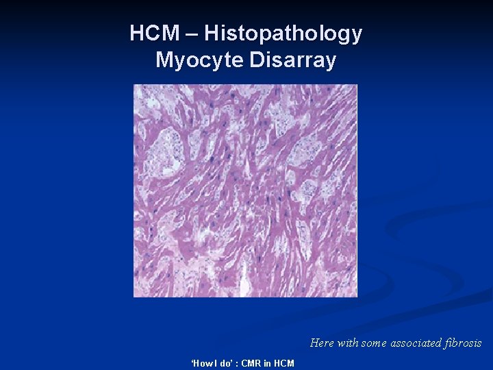 HCM – Histopathology Myocyte Disarray Here with some associated fibrosis ‘How I do’ :
