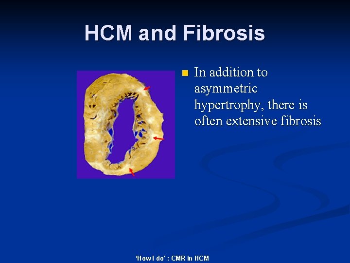 HCM and Fibrosis n In addition to asymmetric hypertrophy, there is often extensive fibrosis