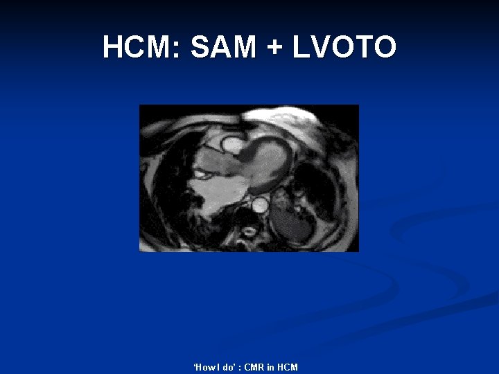 HCM: SAM + LVOTO ‘How I do’ : CMR in HCM 