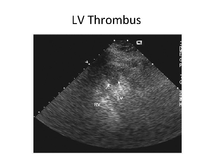 LV Thrombus 