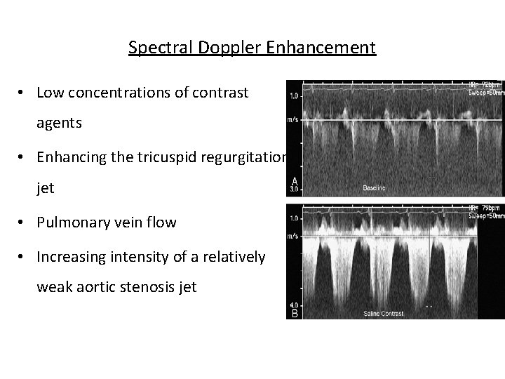 Spectral Doppler Enhancement • Low concentrations of contrast agents • Enhancing the tricuspid regurgitation