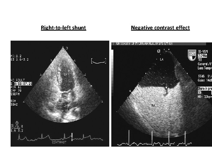 Right-to-left shunt Negative contrast effect 