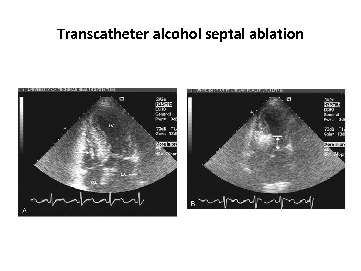 Transcatheter alcohol septal ablation 