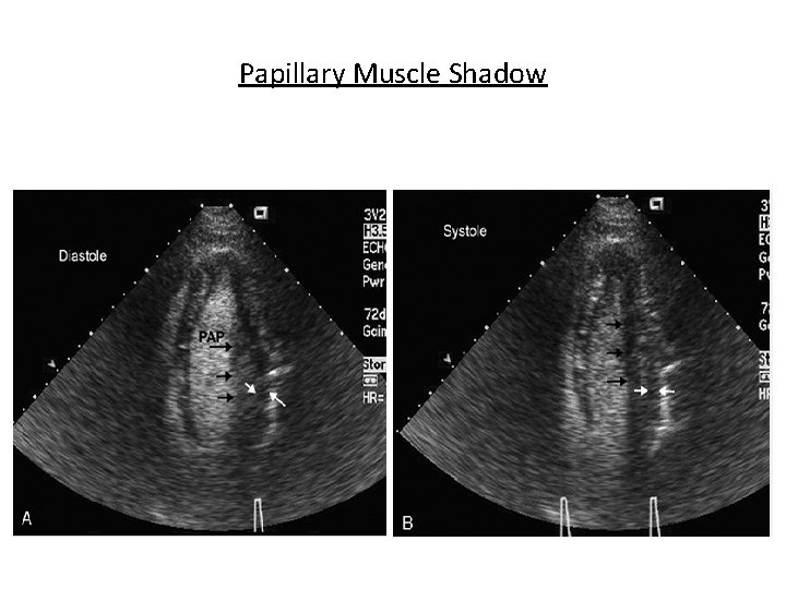 Papillary Muscle Shadow 