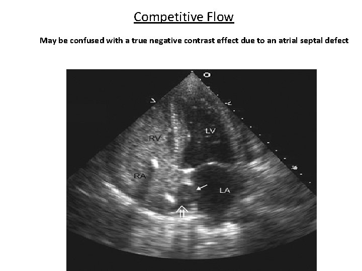 Competitive Flow May be confused with a true negative contrast effect due to an