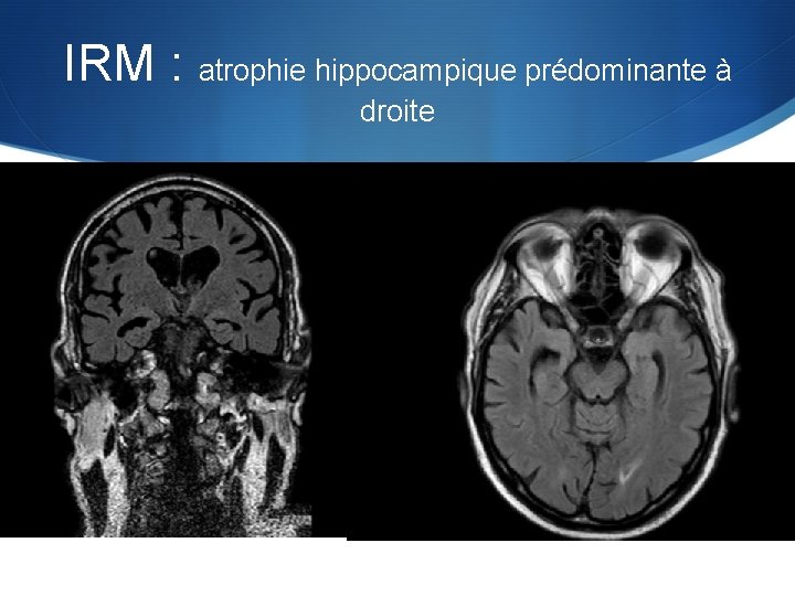 IRM : atrophie hippocampique prédominante à droite 