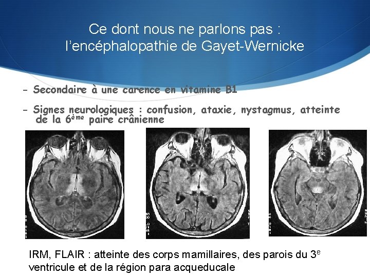 Ce dont nous ne parlons pas : l’encéphalopathie de Gayet-Wernicke - Secondaire à une