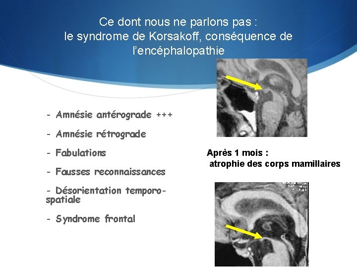 Ce dont nous ne parlons pas : le syndrome de Korsakoff, conséquence de l’encéphalopathie