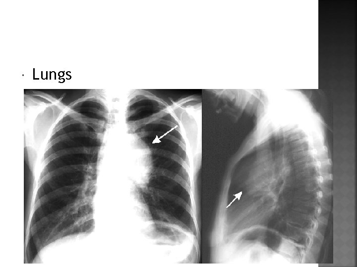  Lungs 