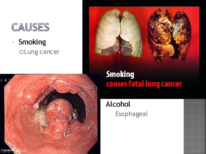  Smoking Lung cancer Alcohol Esophageal Ø carcinoma 