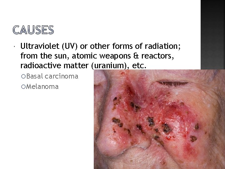  Ultraviolet (UV) or other forms of radiation; from the sun, atomic weapons &